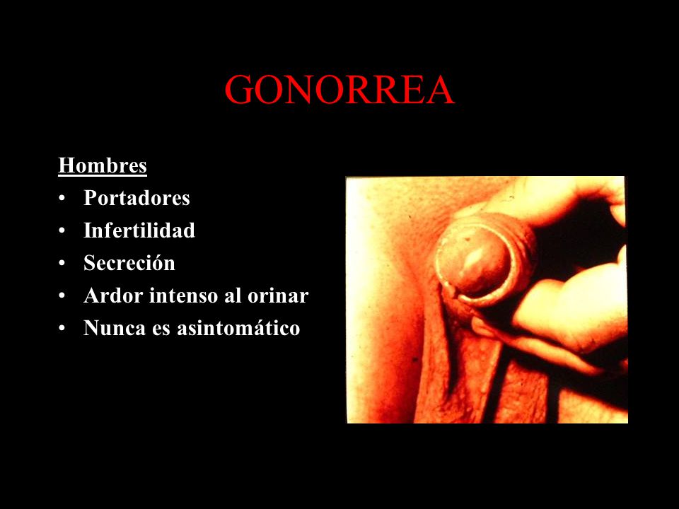 Ardor al orinar hombre ets